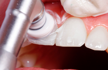 Что такое профессиональная чистка зубов?