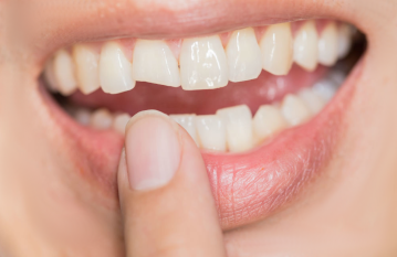 Откололся кусочек зуба. Возможно ли восстановление его прежней формы?