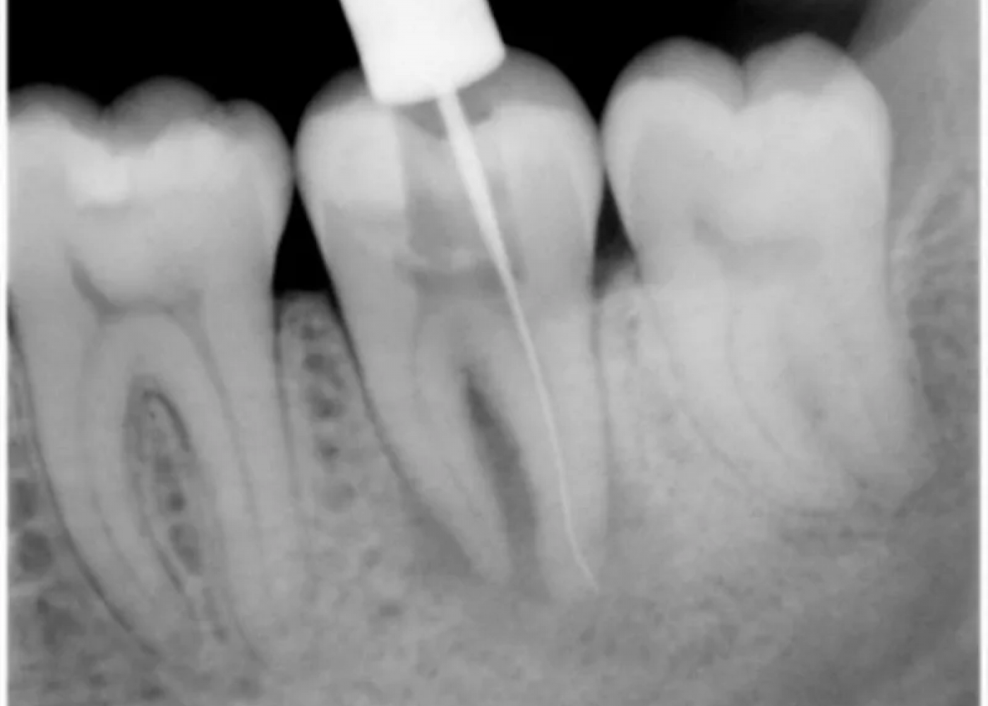 Снимок зубов на этапе лечения