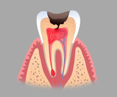 Чувствительность зубов
