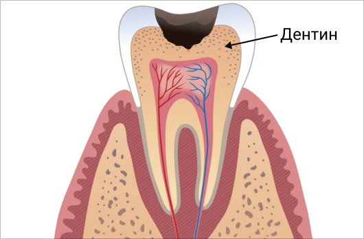 Кариес проник в дентин зуба