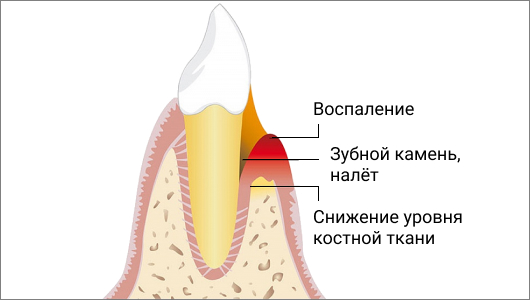 Пародонтоз на зубе наглядно