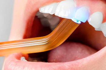 Какие виды зубных пломб ставят в стоматологии ЭлитДентал М.