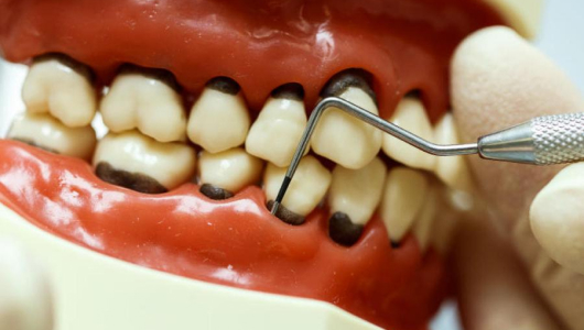 Влияение пародонтоза на зубы наглядно