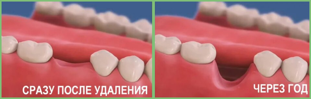 Длительное отсутствие зуба в десне