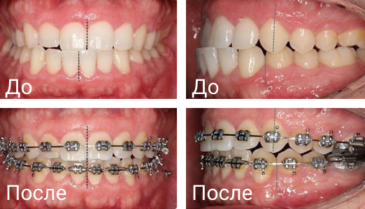 Результат от брекетов Результат от брекетов