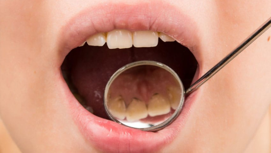 Лечение пятен на зубах