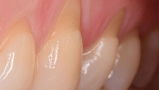 Симптомы повышенной чувствительности зубов