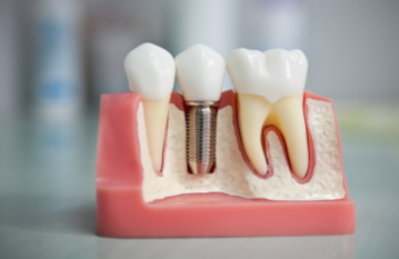 Можно ли сохранить разрушенный зуб?