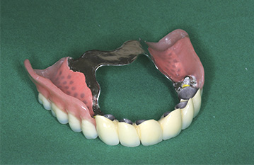 Бюгельный протез. Восстановление зубного ряда