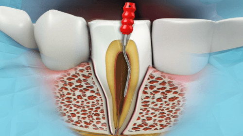 Заболевание зубов